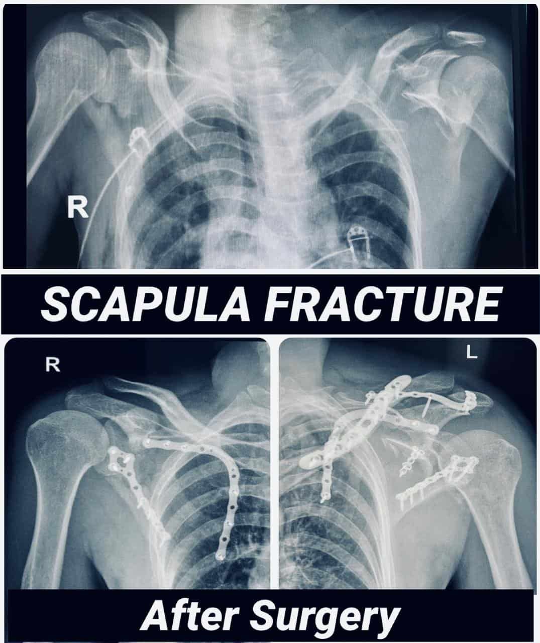 Complex Scapula Fracture Successfully Treated With Surgical Fixation ...